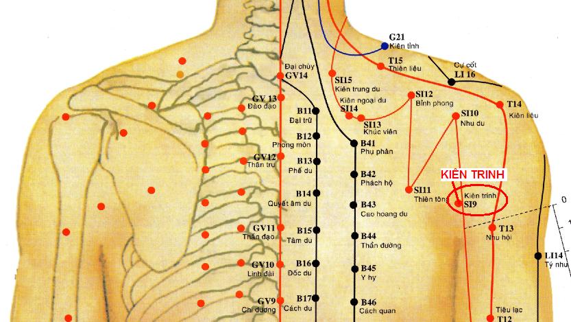 Triệu chứng cơ năng, thực thể, các huyệt cần châm để điều trị bệnh nhân đau thắt lưng cấp do lạnh